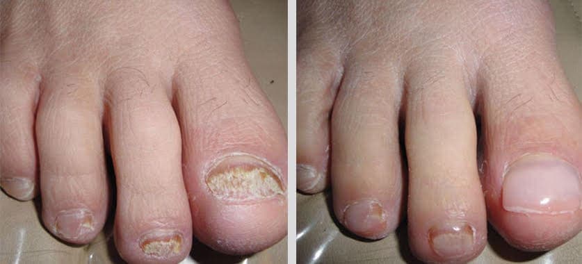 KeryFlex nail restoration before and after
